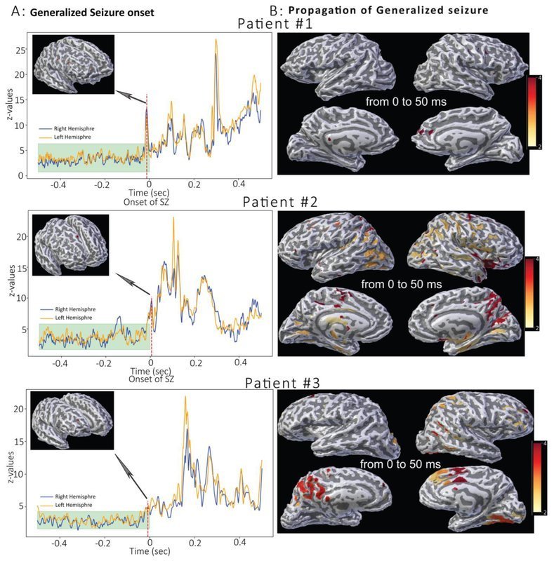 Generalized seizure onset and propagation analysis across three patients