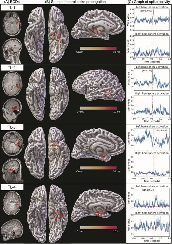Spatiotemporal spike propagation analysis across four temporal lobe epilepsy patients